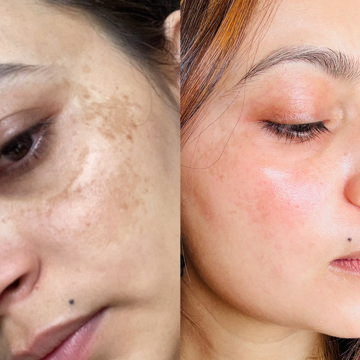 Before and after comparison of a woman's face with visible skin issues.